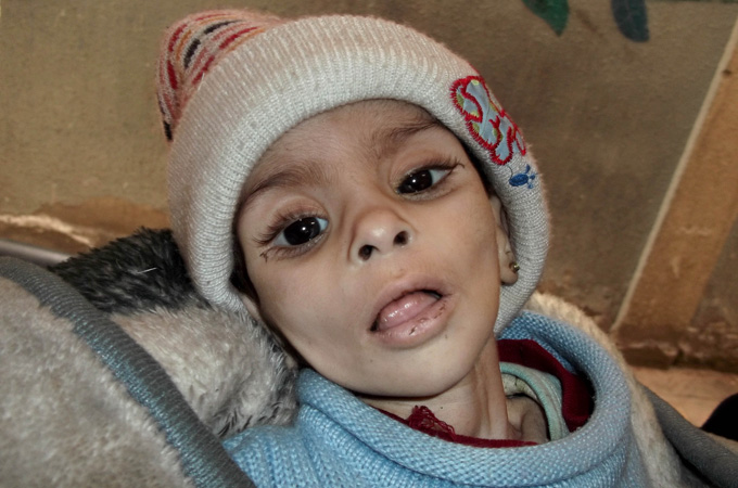 Baby Israa al-Masri died of a hunger-related illness on January 11, 2014 in the Yarmouk camp [AP]