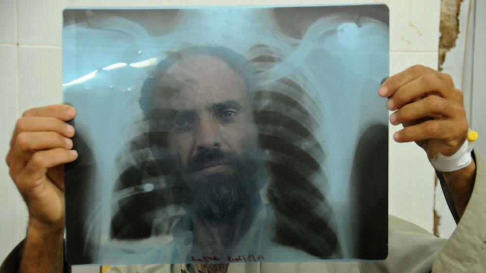 Tuberculosis