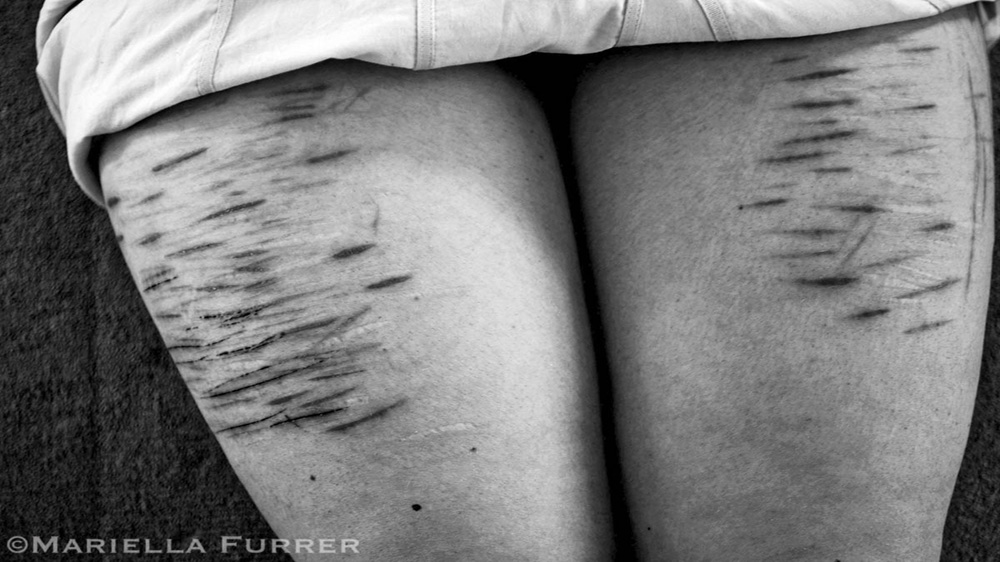 The mutilated legs of Susanna. Initiated into a satanic cult at the age of eight, Susanna, 24, suffers from Dissociative Identity Disorder (DID). Having endured severe ritualistic sexual abuse for almost 18 years, she developed DID as a coping mechanism and has more than 200 different identities, many of whom are self-mutilators. The initiations involved many forms of sexual abuse, including bestiality, gang rapes and child pornography. December 2008 [Mariella Furrer]