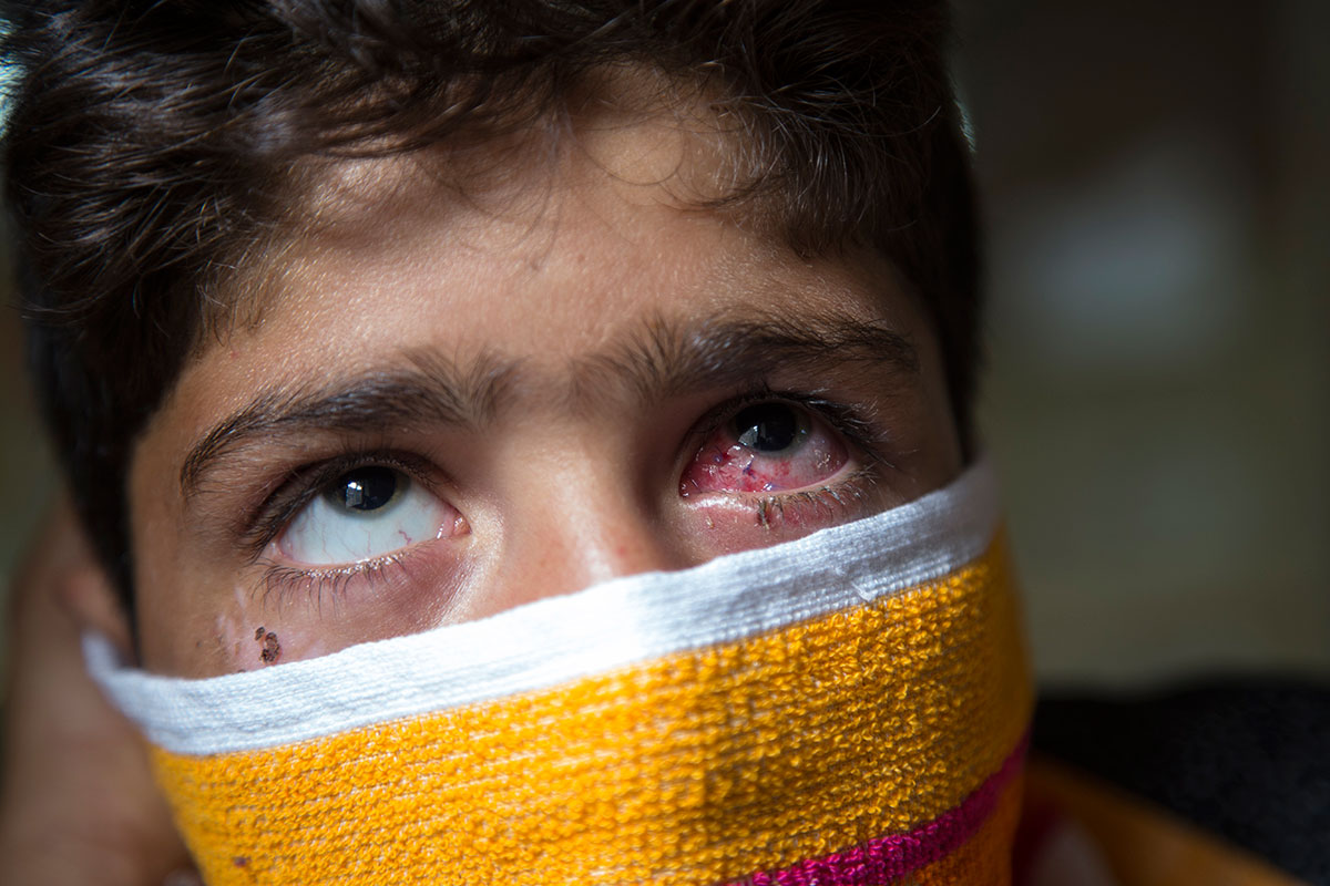 Pellet Injuries/ Please Do Not Use