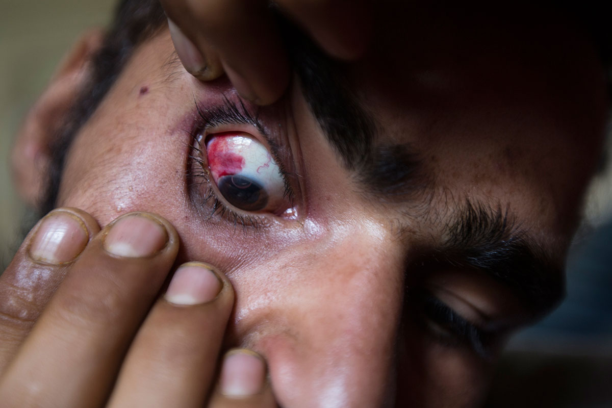 Pellet Injuries/ Please Do Not Use