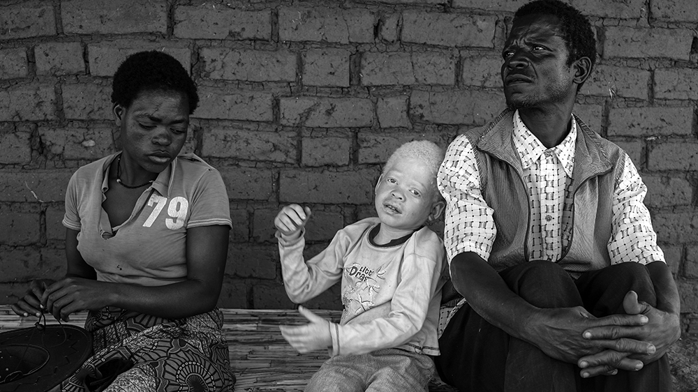 Explainer albinism