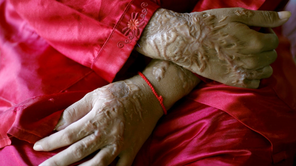 Cambodia acid scars