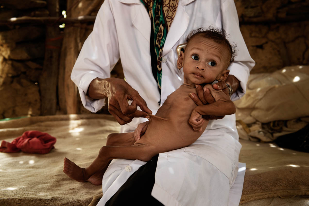 Province of Hajja, the areas most affected by malnutrition and cholera.