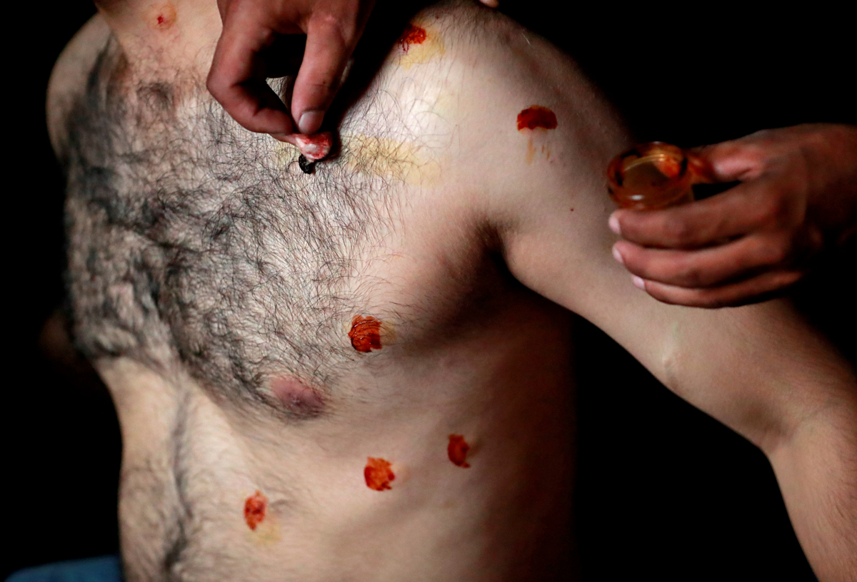 A man with pellet injuries is treated inside a house in a neighbourhood where there have been regular clashes with Indian security forces following restrictions after the government scrapped the speci