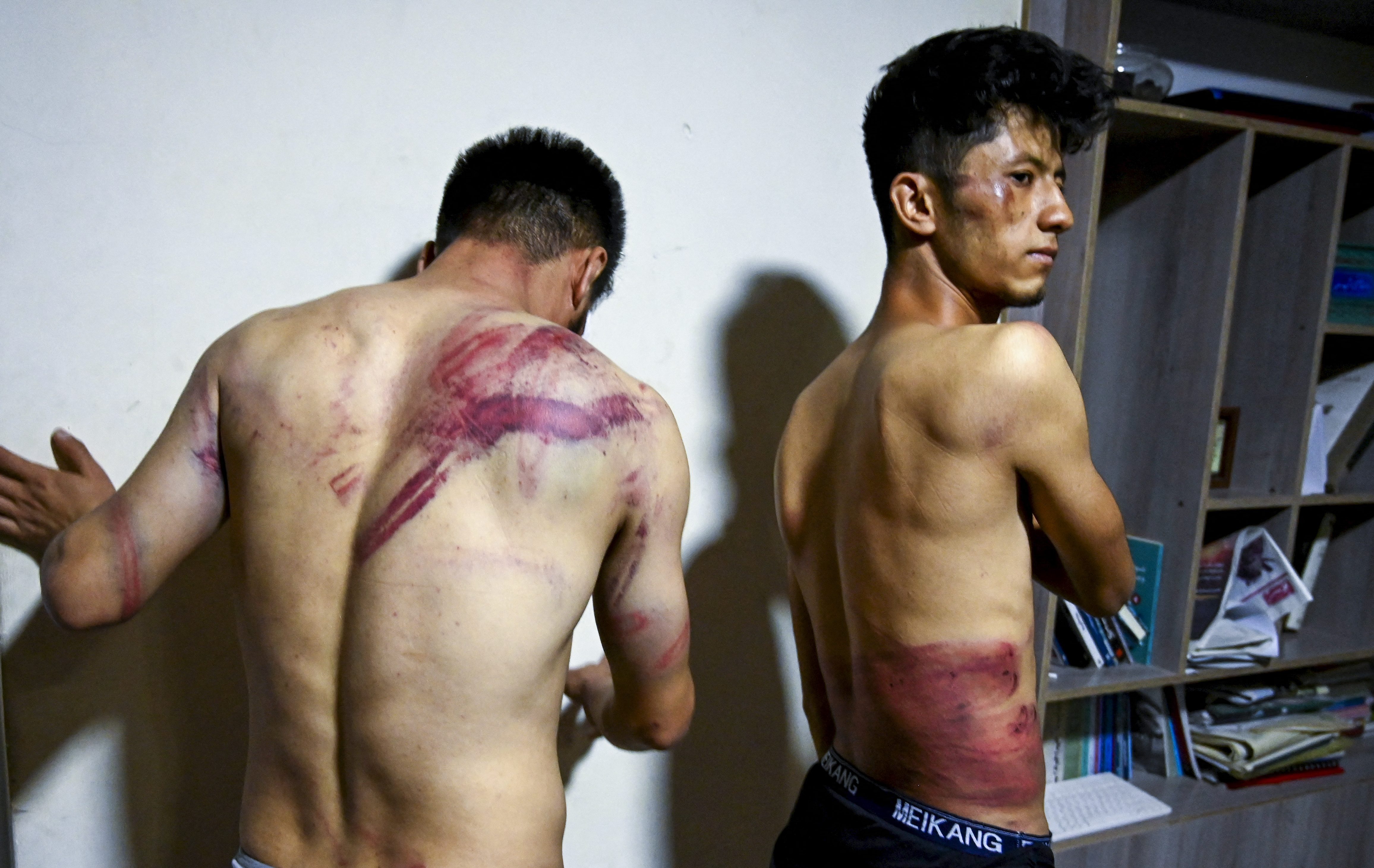 Afghan journalists Nematullah Naqdi (L) and Taqi Daryabi show their wounds in their office in Kabul after being released from Taliban custody