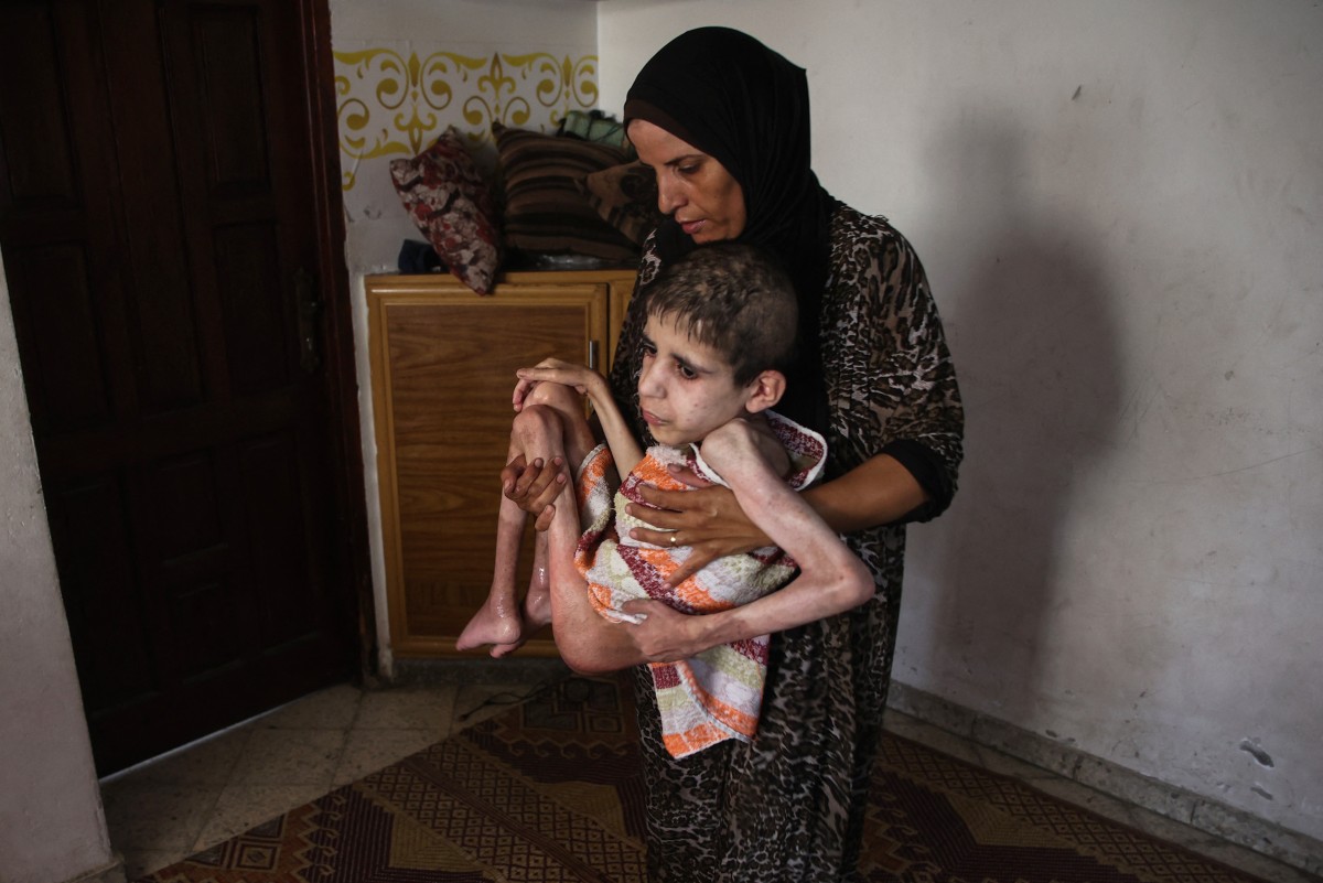 Palestinian man Bahaa al-Nimr, 19, who suffers from cerebral palsy and malnutrition