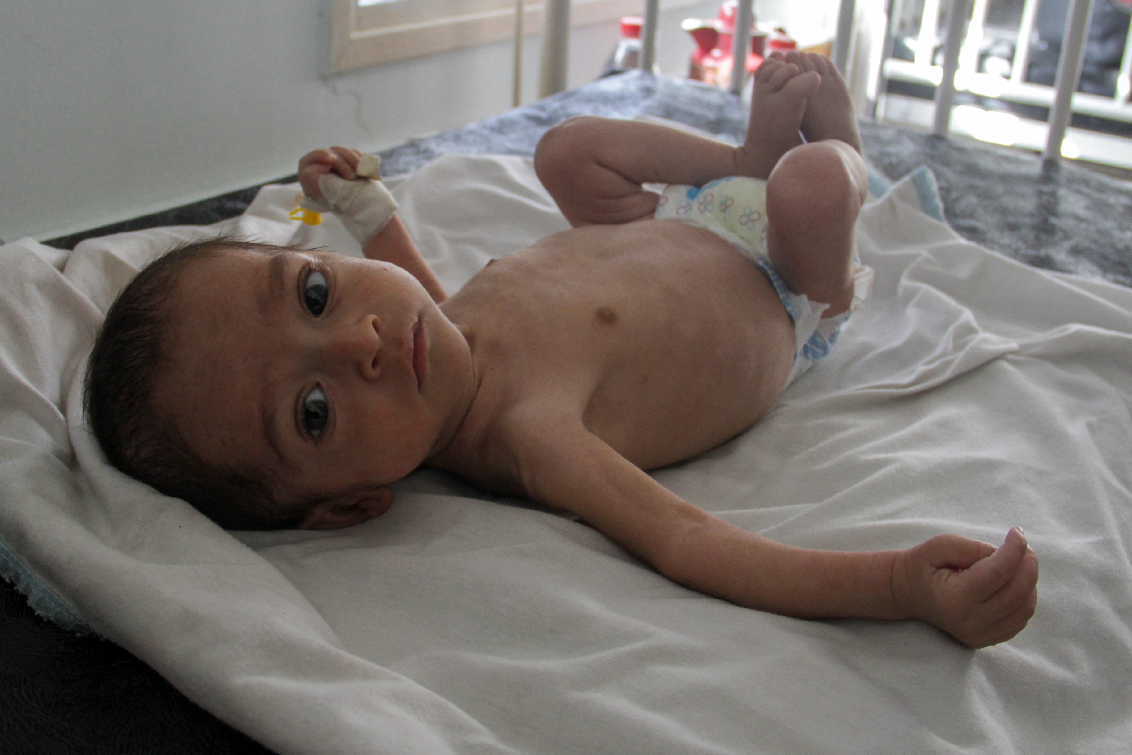 Majd Salem, a six-month-old malnourished Palestinian baby who weighed 3.5 kg when he was born and gained just 300 grams in six months, lies on a bed as he receives treatment at Kamal Adwan hospital in the northern Gaza Strip May 9, 2024. REUTERS/Mahmoud Issa
