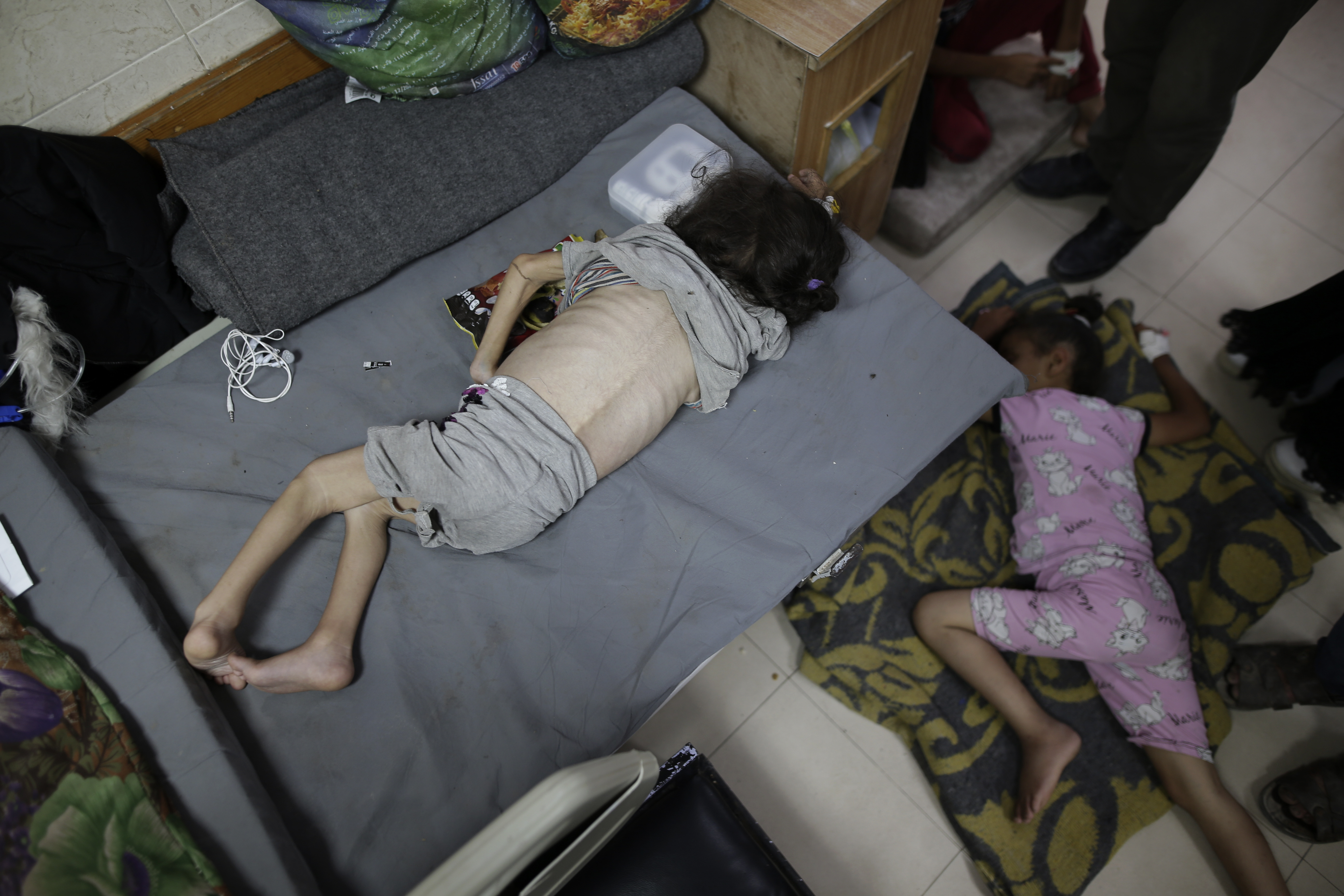 A three-year-old child who suffers from diabetes, a weakened immune system and malnutrition, rests at Al-Aqsa Martyrs Hospital on June 1, 2024