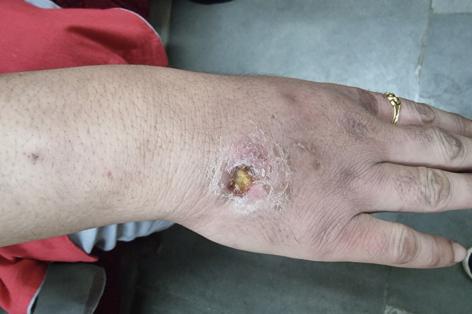 Afiya’s hand with a large wound caused by injecting heroin