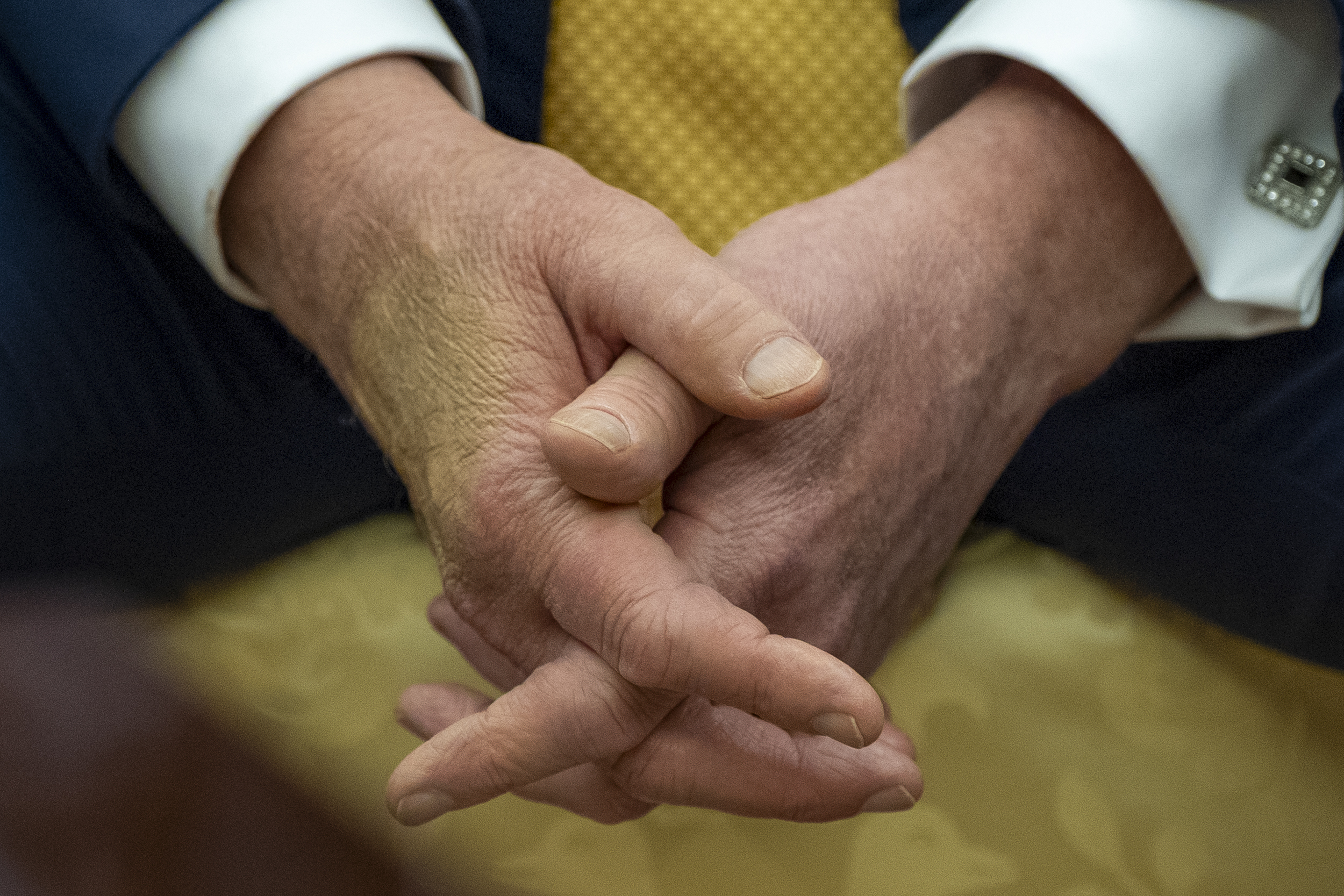 Apparent bruising is seen on Trump’s hand at the White House in Washington, DC
