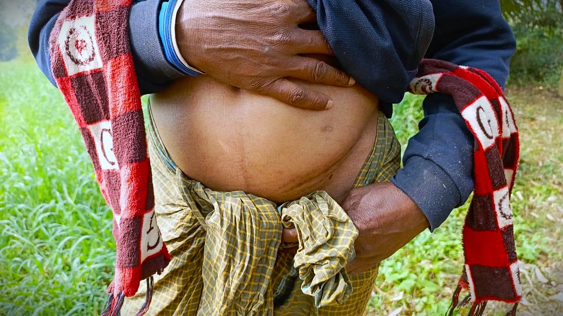 Safirrudin showing his scar because of the kidney transplant