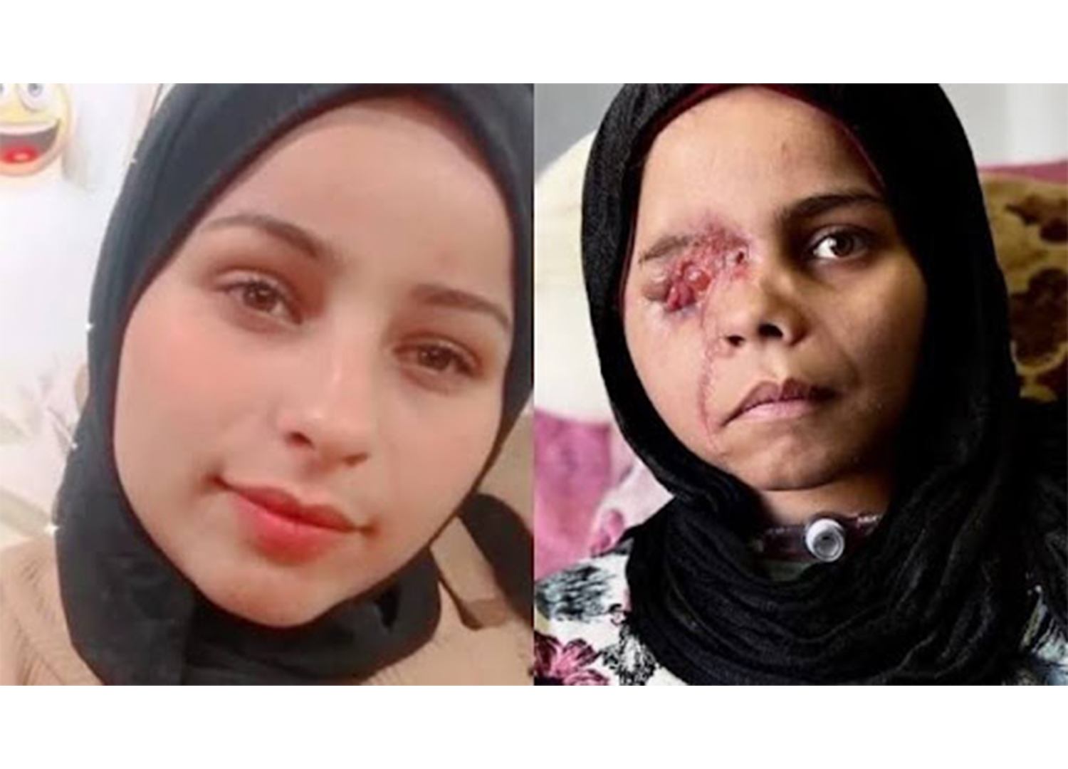 A photo showing Nada’s condition before and after the injury [Courtesy of Abdul Rahman Arhouma]